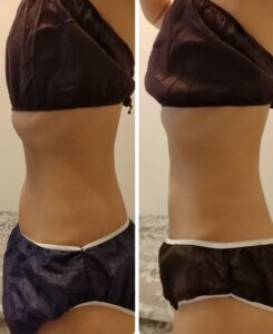 脂肪冷却瘦身 before After