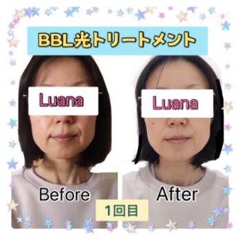 BBL光トリートメントの施術レポート