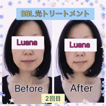 BBL光トリートメントの施術レポート