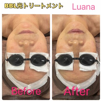 たるみ・ほうれい線へのアプローチ「BBL光トリートメント」施術