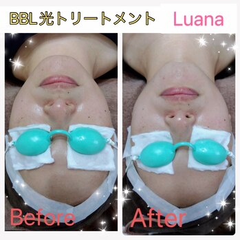 お肌のお悩み解決します！BBL光トリートメント