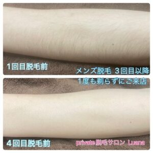 脱毛ビフォーアフター