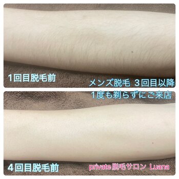 脱毛ビフォーアフター