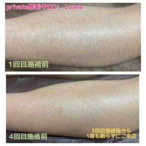 脱毛ビフォーアフター