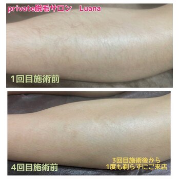 脱毛ビフォーアフター