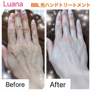 BBL光ハンドトリートメント