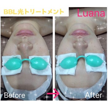 「BBL光トリートメント」のご紹介