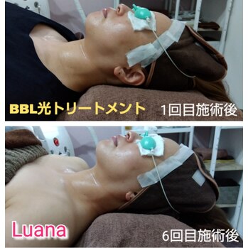 「BBL光トリートメント」のご紹介