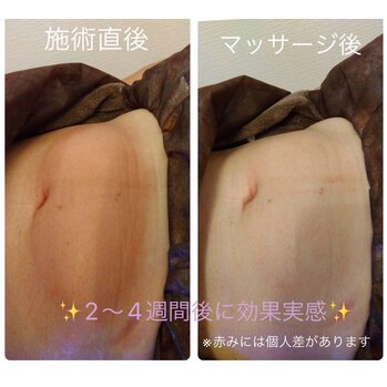 脂肪冷却痩身マシン、施術の様子