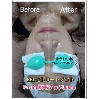 BBL光トリートメントでふっくら若々しいお肌へ