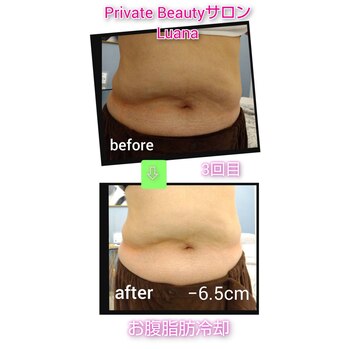「脂肪冷却ダイエット」、ビフォーアフターご紹介