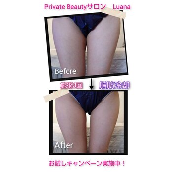 夏前に気になる脂肪、すっきりさせませんか