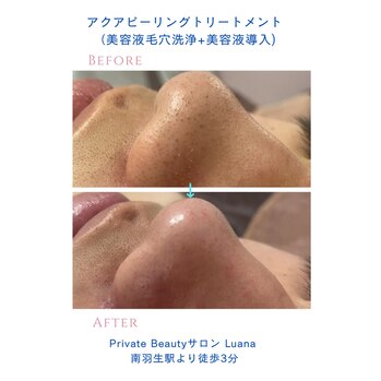 美容液毛穴洗浄・美容液導入