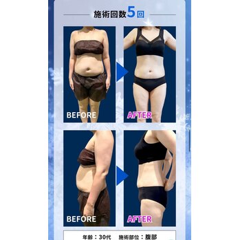 脂肪冷却ダイエット