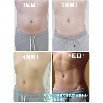 脂肪冷却ダイエット