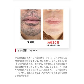 ルミクス脱毛器